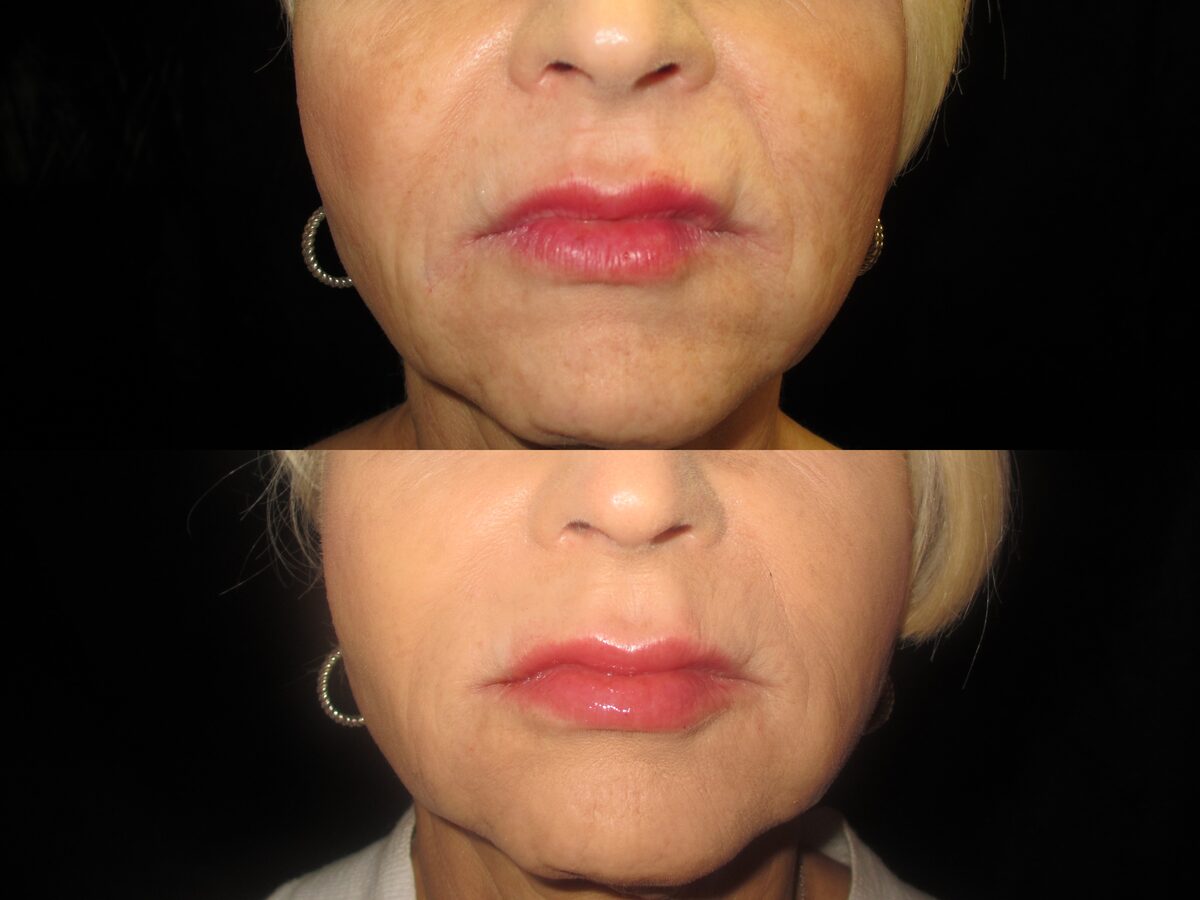 Volumizers & fillers before and after