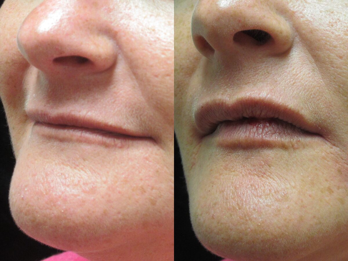 Volumizers & fillers before and after: lips