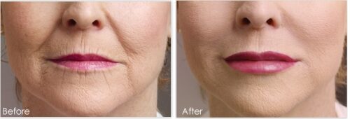 Volumizers & fillers before and after: nasolabial folds