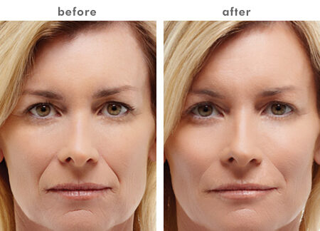 Volumizers & fillers before and after