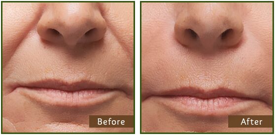 Volumizers & fillers before and after