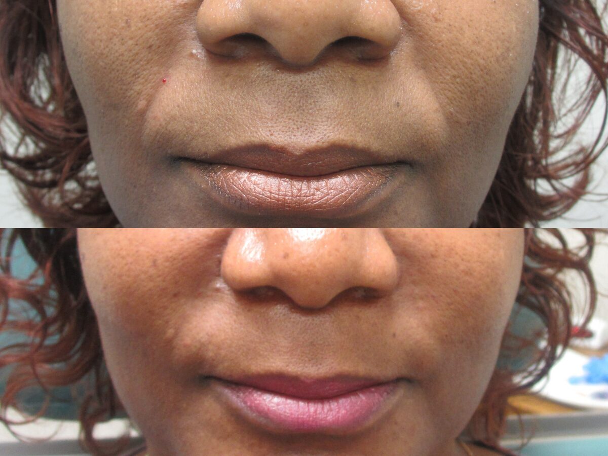 Volumizers & fillers before and after