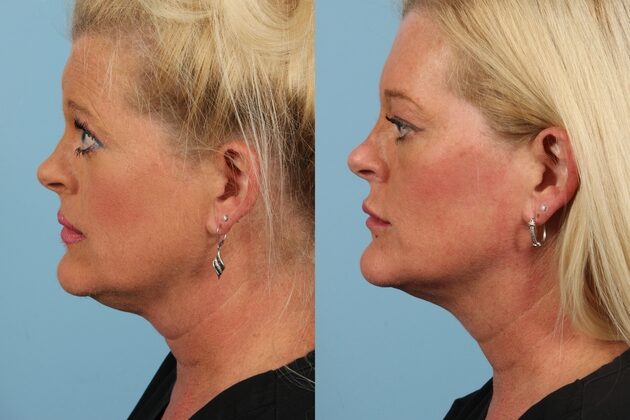 Kybella before and after