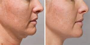 Kybella before and after