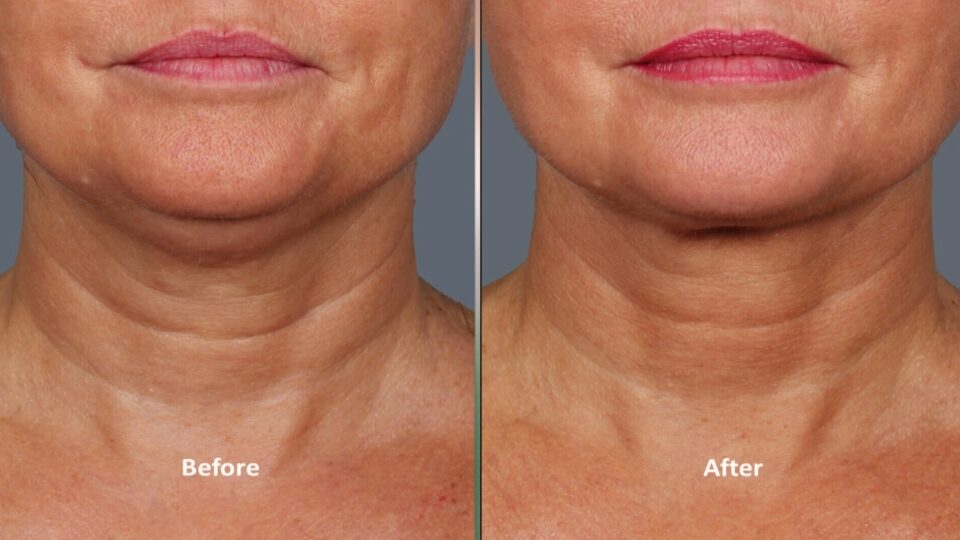 Kybella before and after