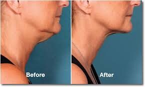 Kybella before and after