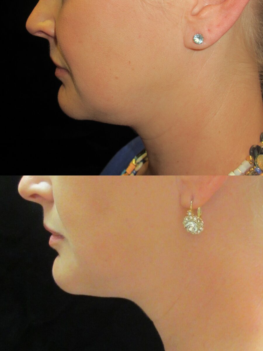 Kybella before and after