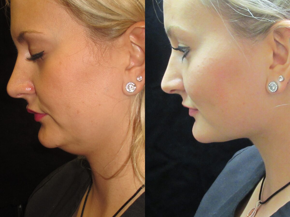 Kybella before and after