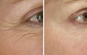 Neuromodulators before and after