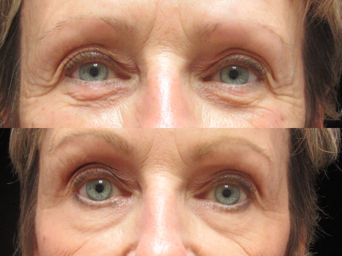 Neuromodulators before and after