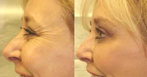 Neuromodulators before and after: smile lines around the eyes