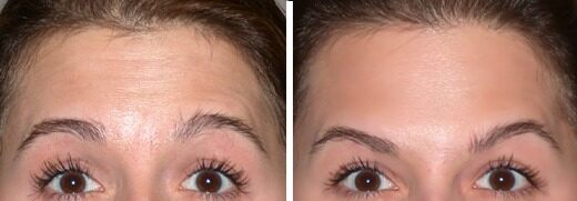 Neuromodulators before and after: upper forehead wrinkles