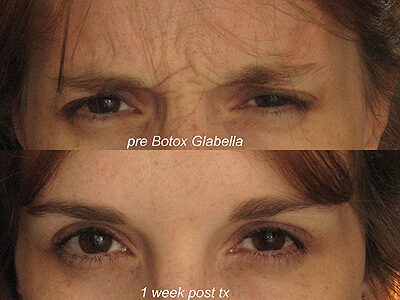 Neuromodulators before and after: lower forehead wrinkles