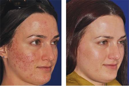 Microneedling before and after