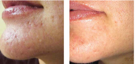 Microneedling before and after