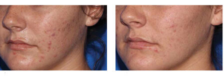 Microneedling before and after