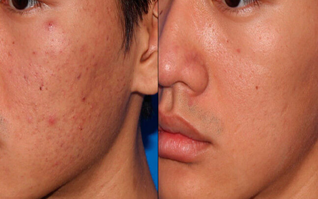 Microneedling before and after
