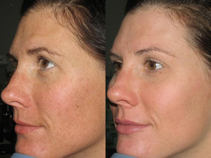 Chemical peels & microdermabrasion before and after