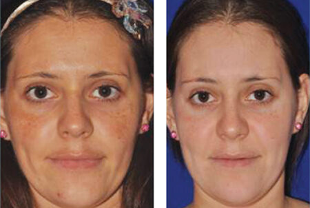 Chemical peels & microdermabrasion before and after