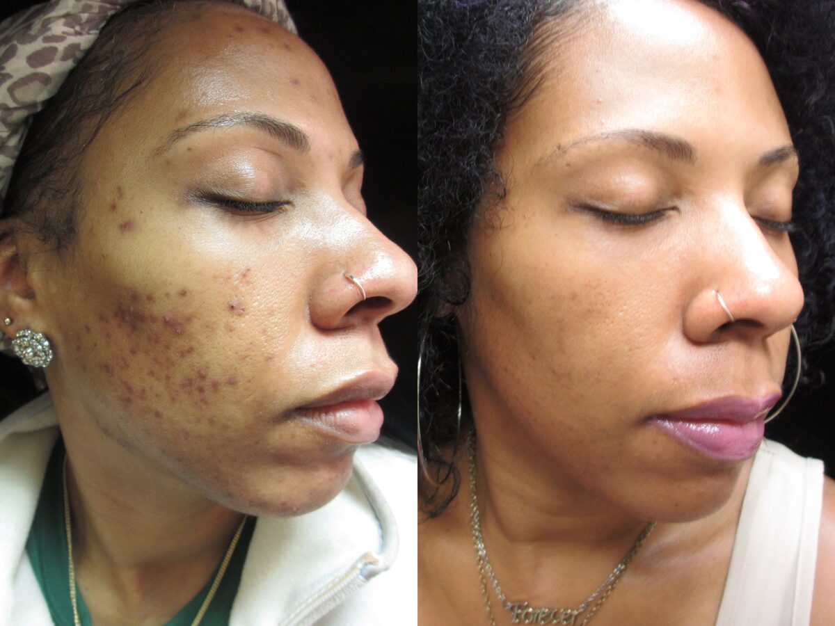 Chemical peels & microdermabrasion before and after