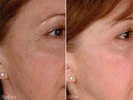 Chemical peels & microdermabrasion before and after