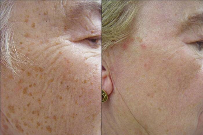 Chemical peels & microdermabrasion before and after