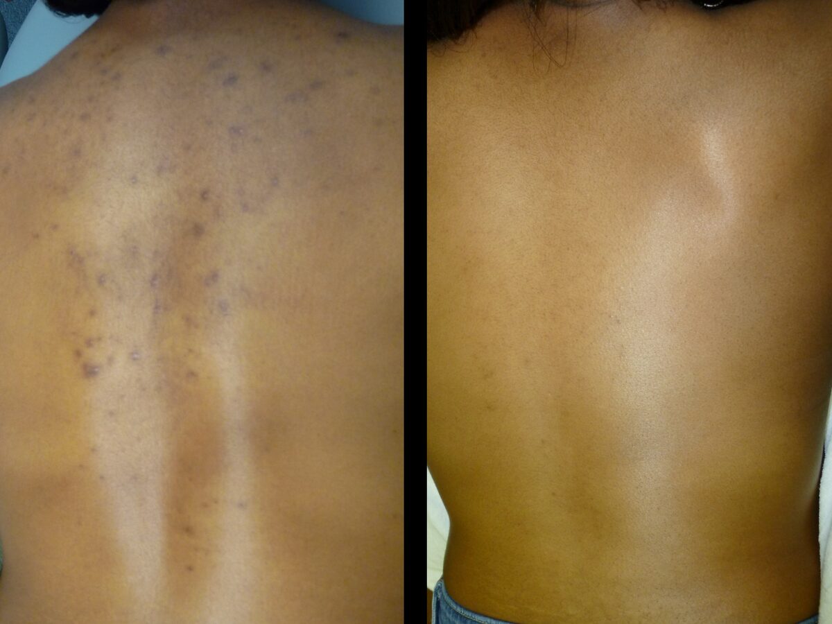 Chemical peels & microdermabrasion before and after