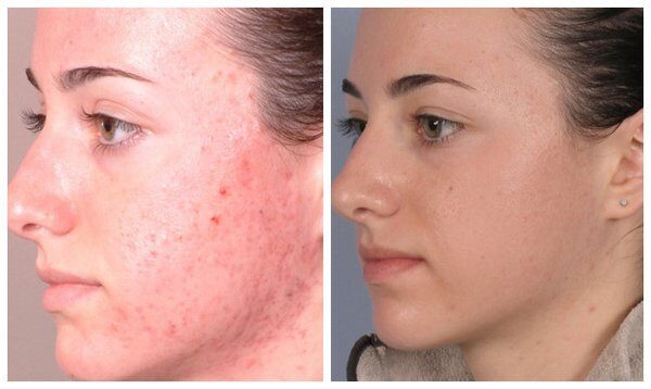 Chemical peels & microdermabrasion before and after