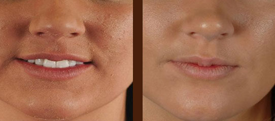Chemical peels & microdermabrasion before and after