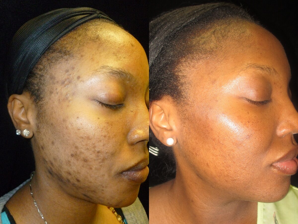 Chemical peels & microdermabrasion before and after