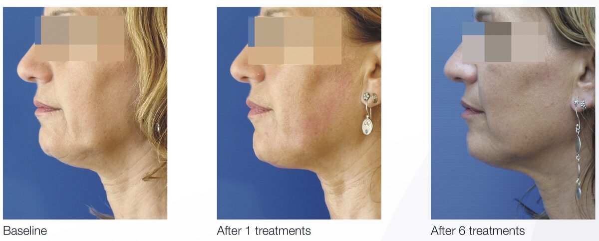 Legend Pro skin tightening before and after