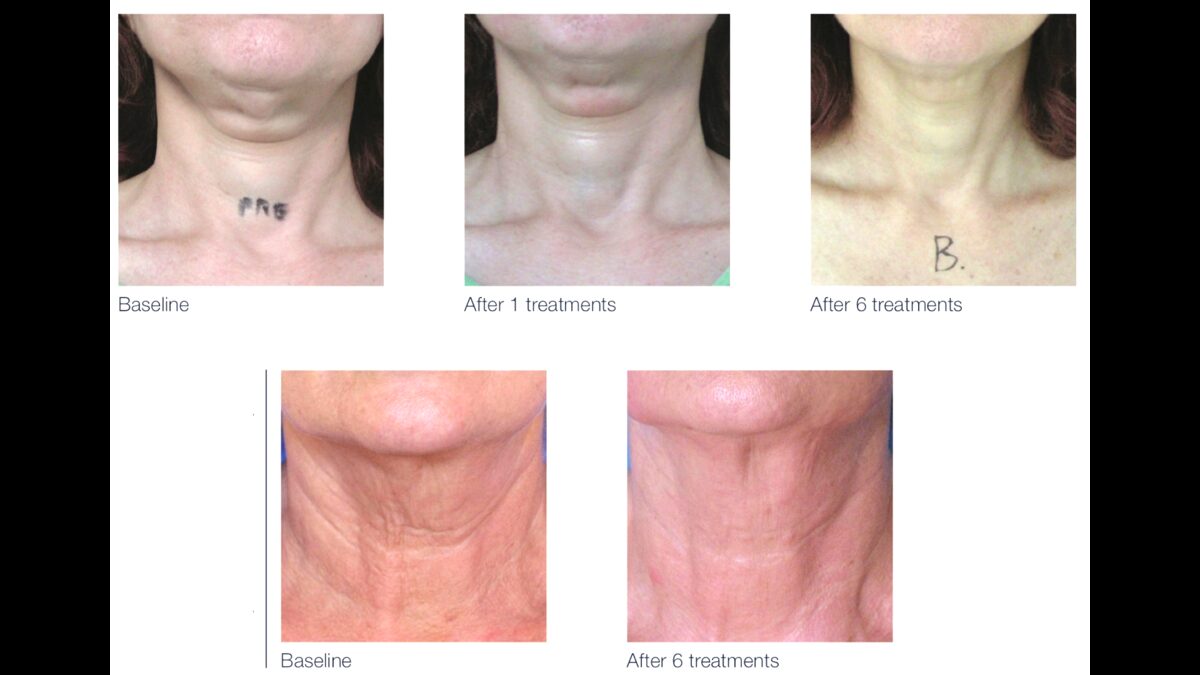 Legend Pro skin tightening before and after