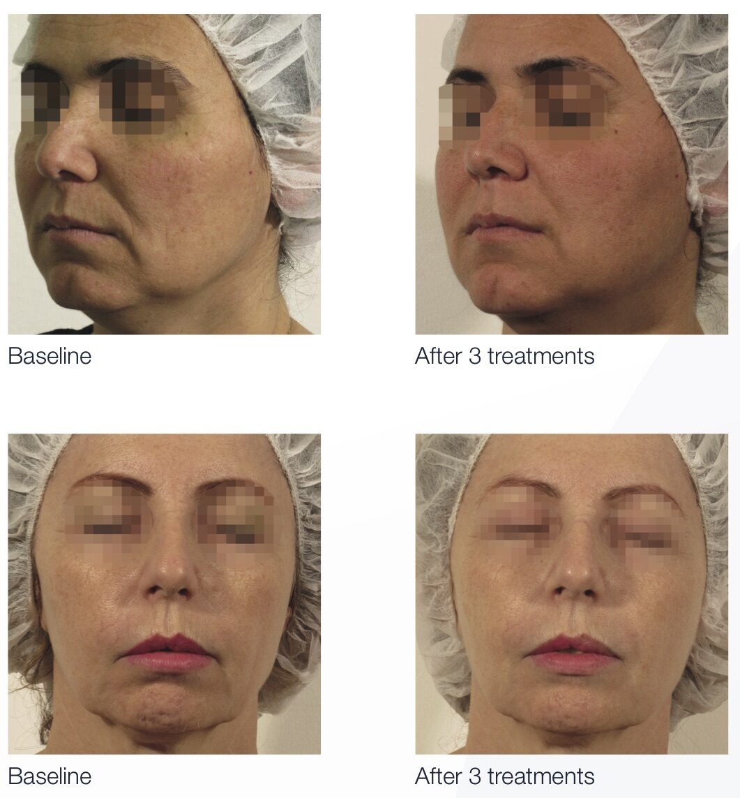 Legend Pro skin tightening before and after